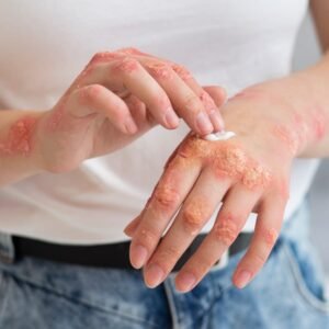 Psoriasis & Rosacea Care